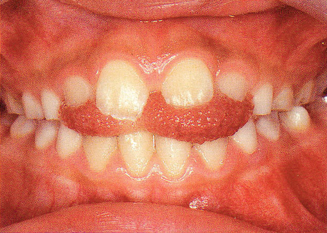 歯で舌を挟むクセがあります